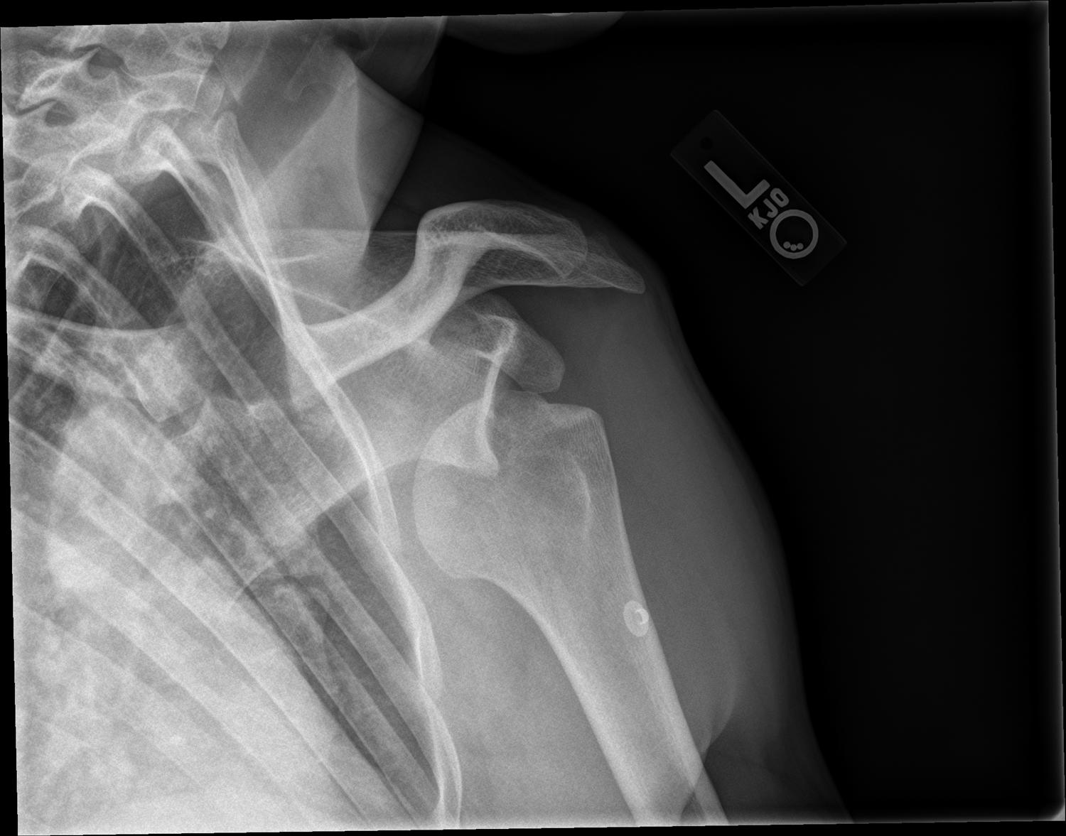 Traumatic Anterior Shoulder Instability (TUBS) Shoulder & Elbow