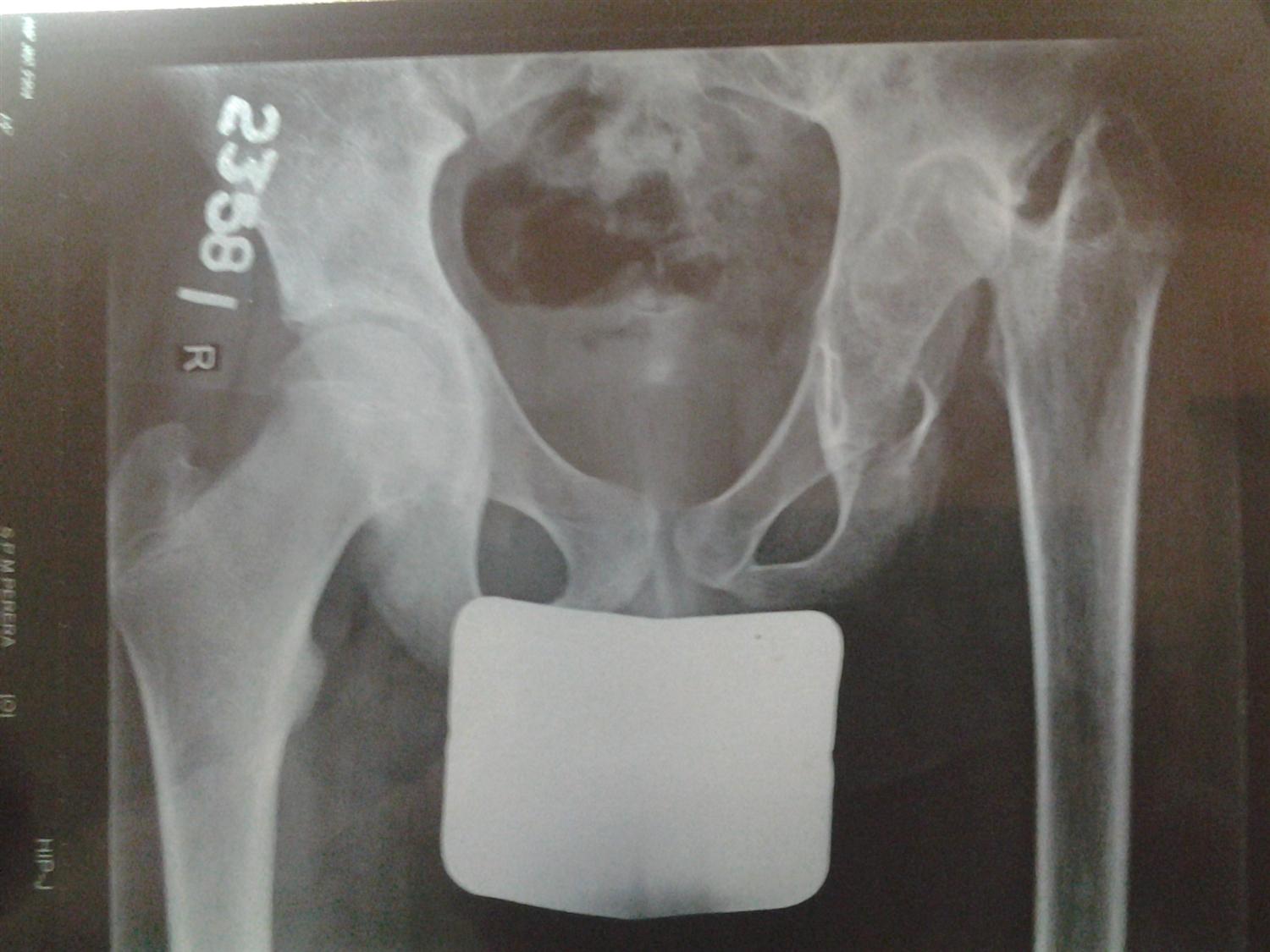 Hip Septic Arthritis Pediatric Pediatrics Orthobullets