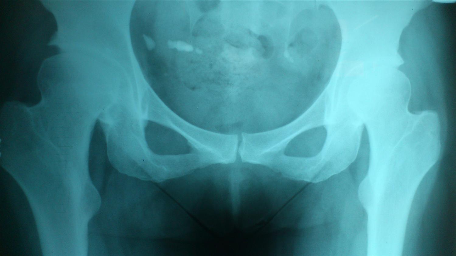 Developmental Dysplasia of the Hip Pediatrics Orthobullets