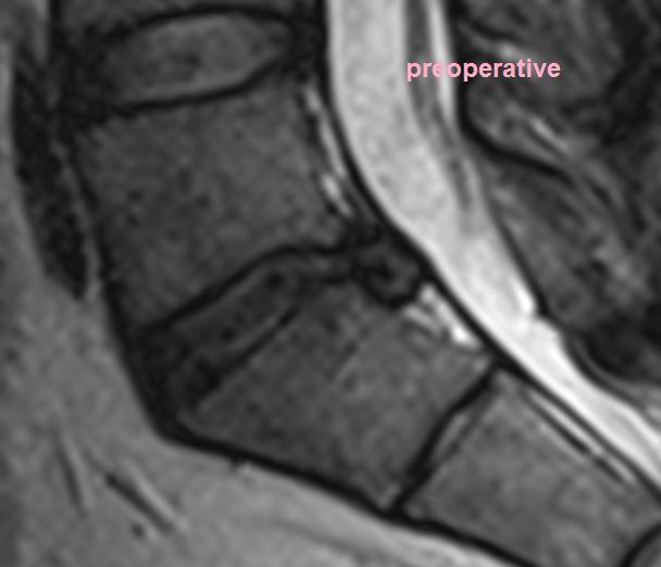 Lumbar Disc Herniation Spine Orthobullets