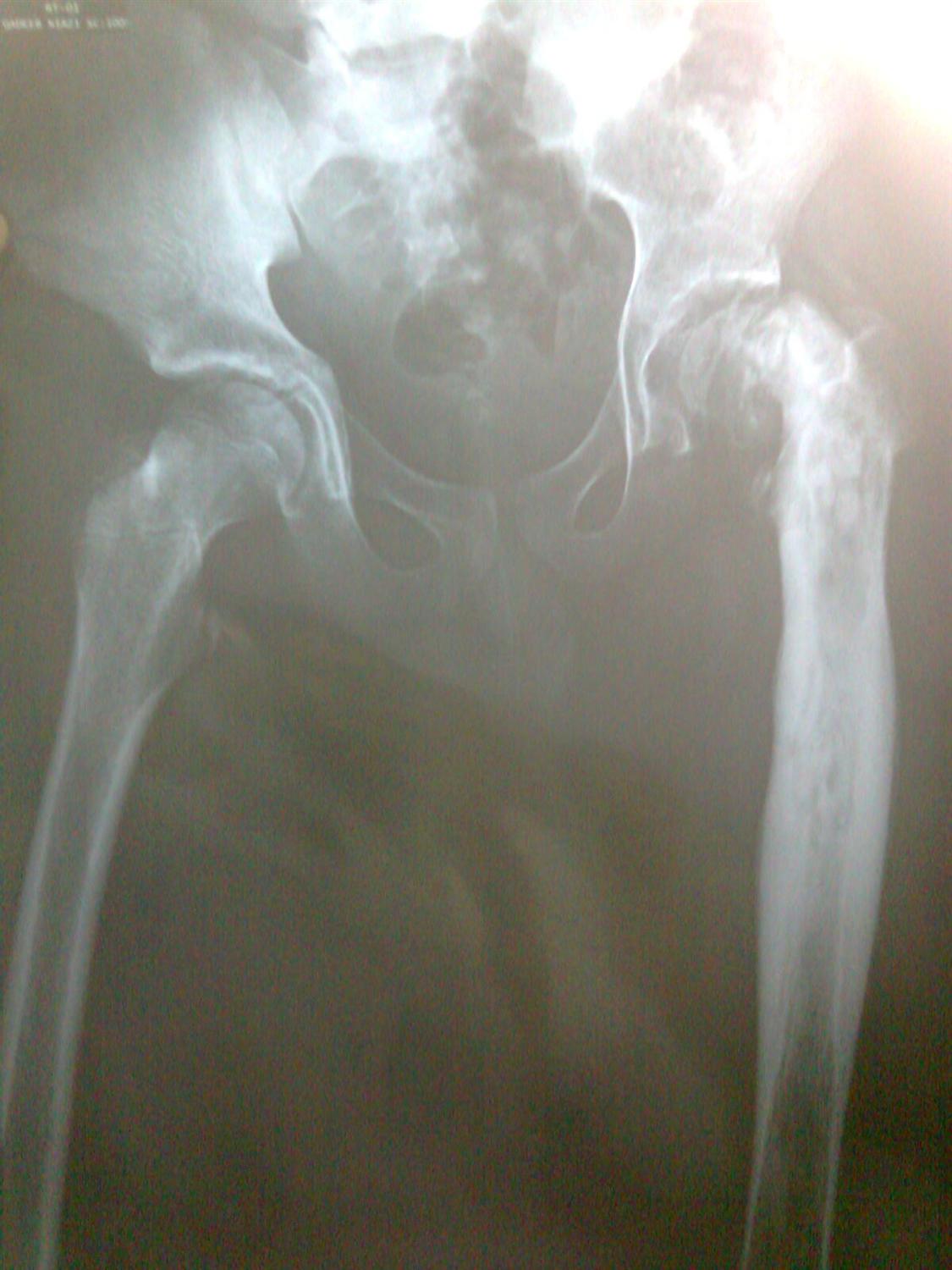 Hip Septic Arthritis Pediatric Pediatrics Orthobullets