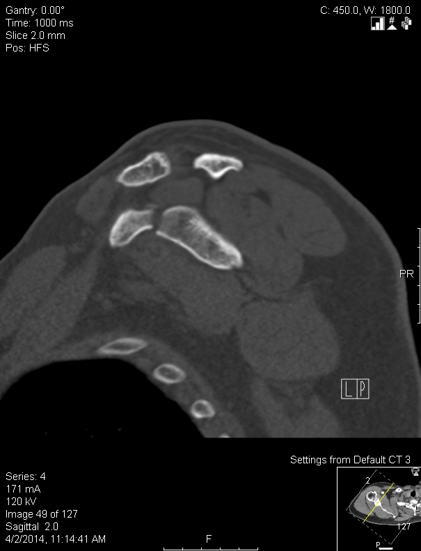 Scapula Fractures Trauma Orthobullets