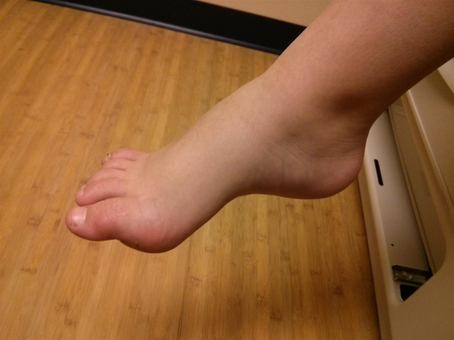 What is valgus foot deformity in a child - causes, signs and treatment methods What is valgus foot deformity in a child - causes, signs and treatment methods