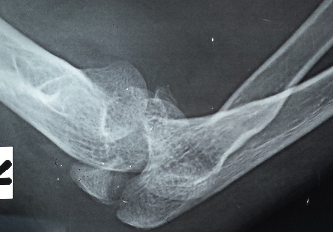 Elbow Dislocation Trauma Orthobullets