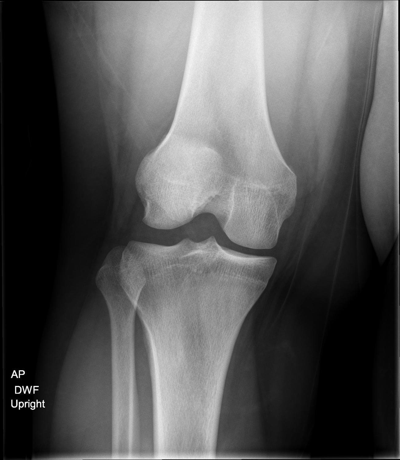 LCL Injury of the Knee Knee & Sports Orthobullets