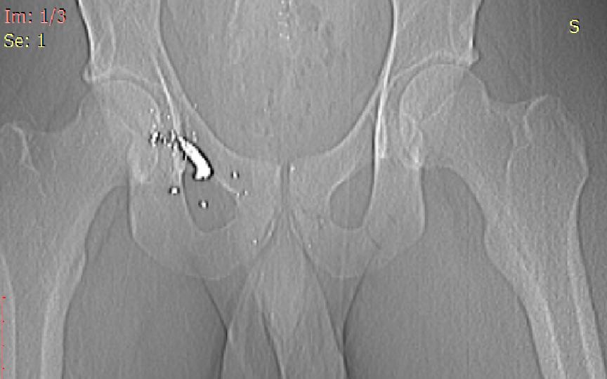 Gun Shot Wounds Trauma Orthobullets