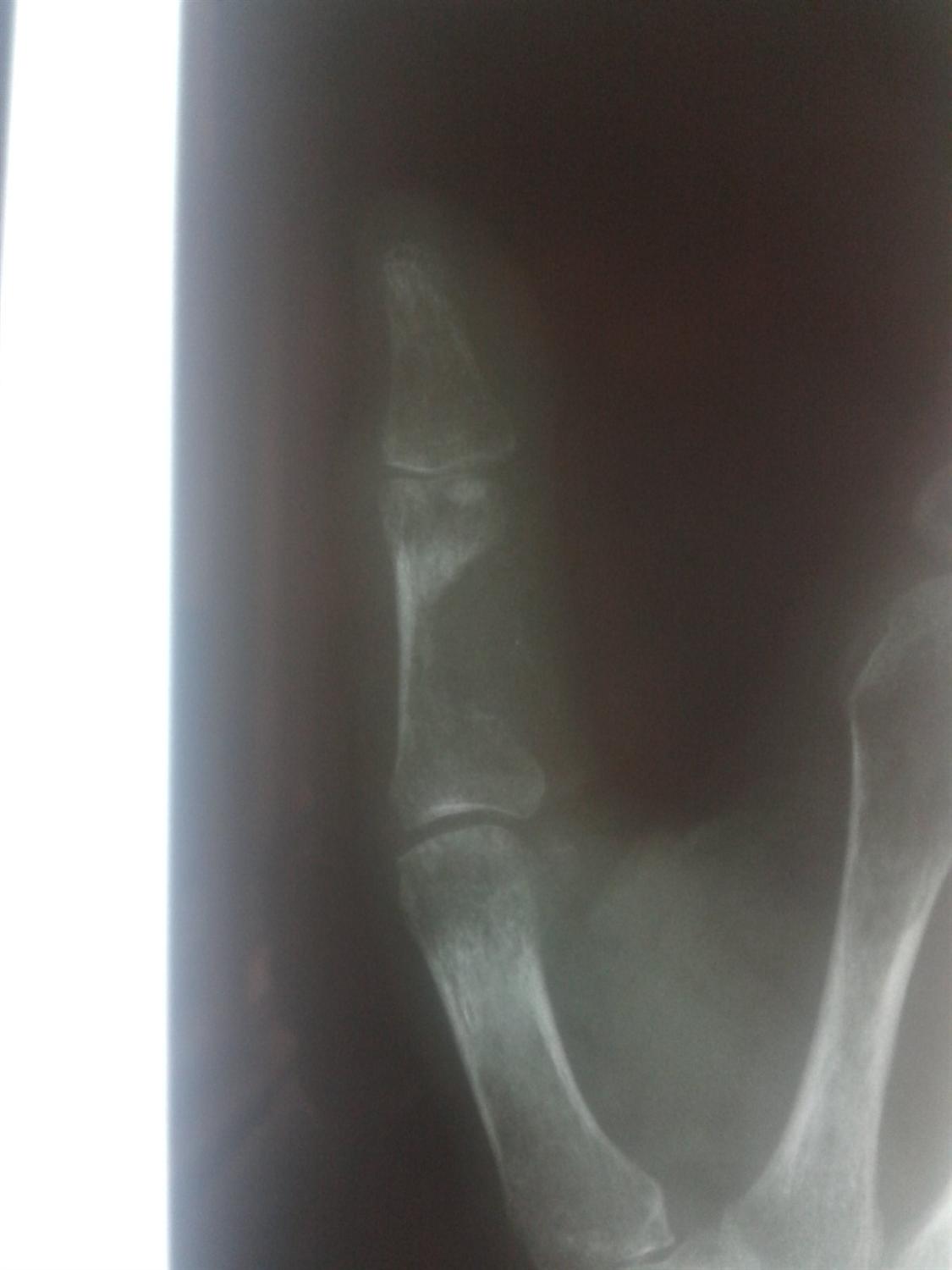 Seymour Fracture Hand Orthobullets