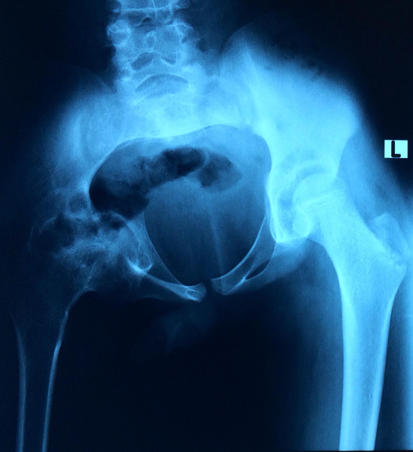 Forearm Compartment Syndrome Neonate Trauma Orthobullets