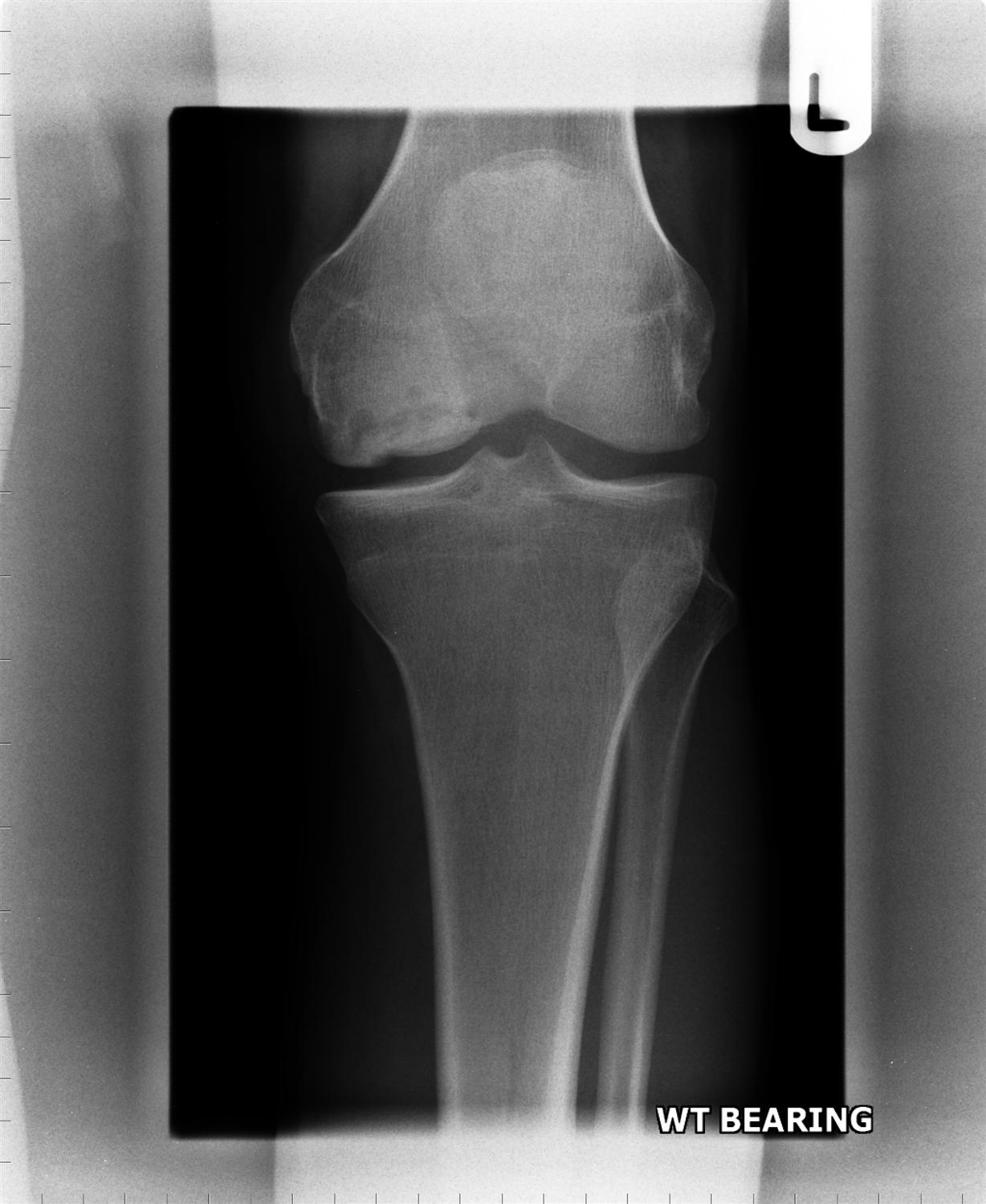 Osteochondritis Dissecans Knee & Sports Orthobullets