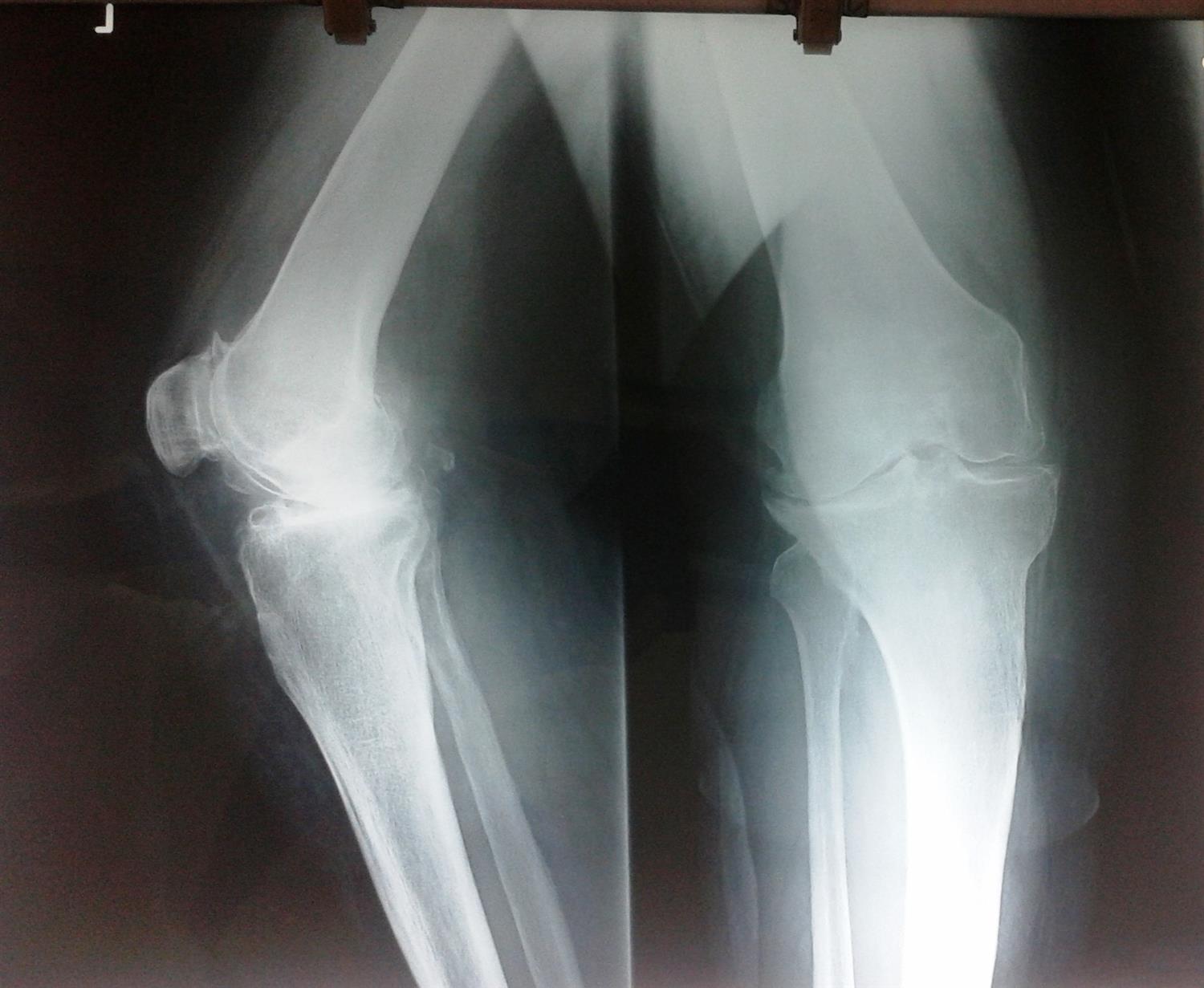 TKA Coronal Plane Balancing Recon Orthobullets