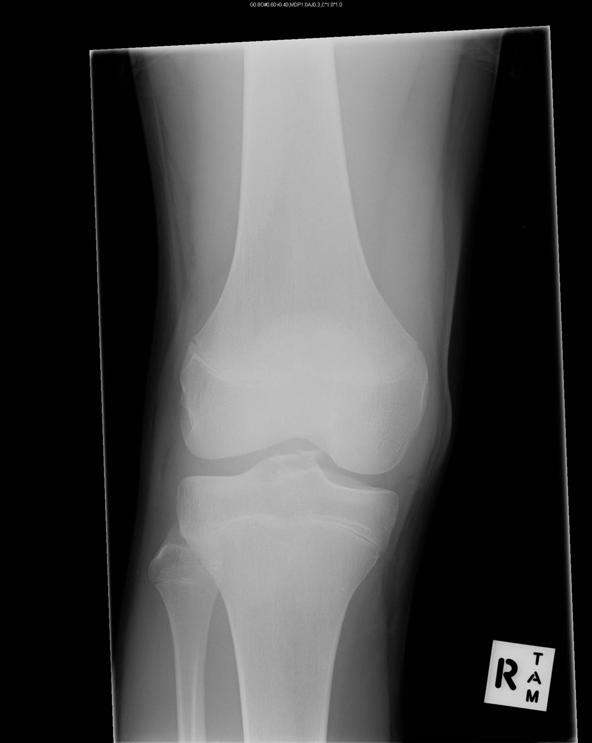 PCL Injury Knee & Sports Orthobullets