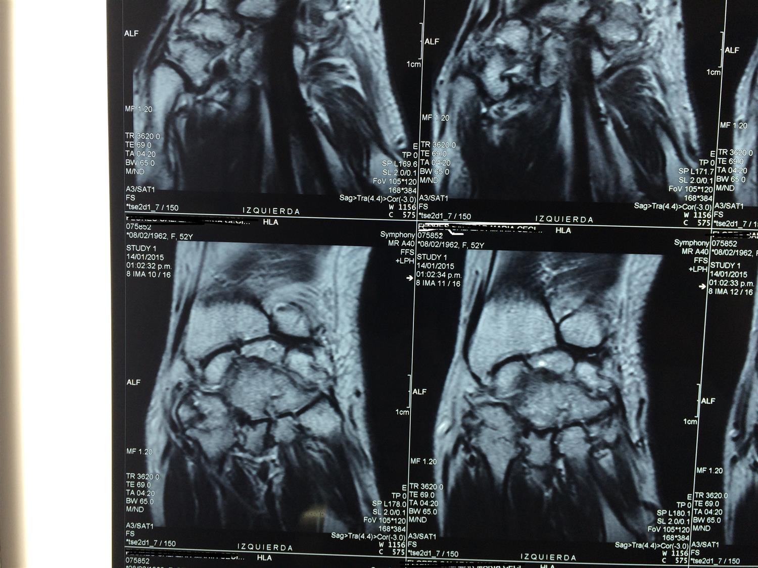 Wrist Arthritis Hand Orthobullets