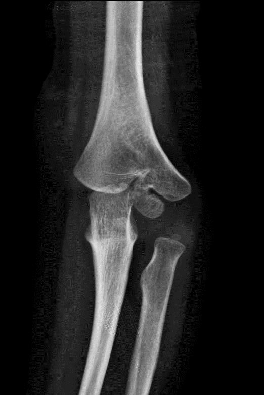 Supracondylar Fracture Pediatric Pediatrics Orthobullets