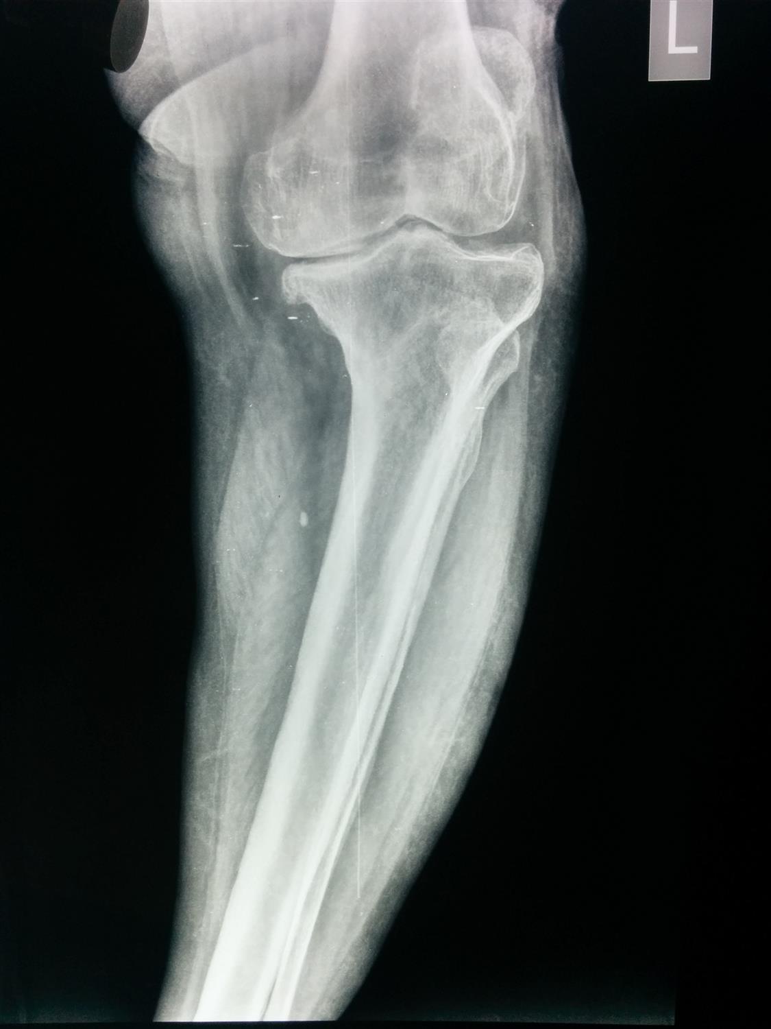 TKA Sagittal Plane Balancing Recon Orthobullets