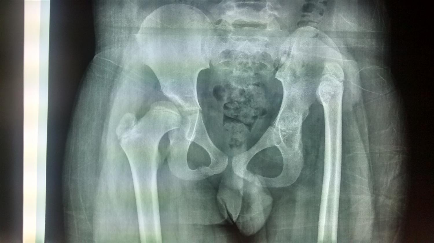 Developmental Dysplasia of the Hip Pediatrics Orthobullets