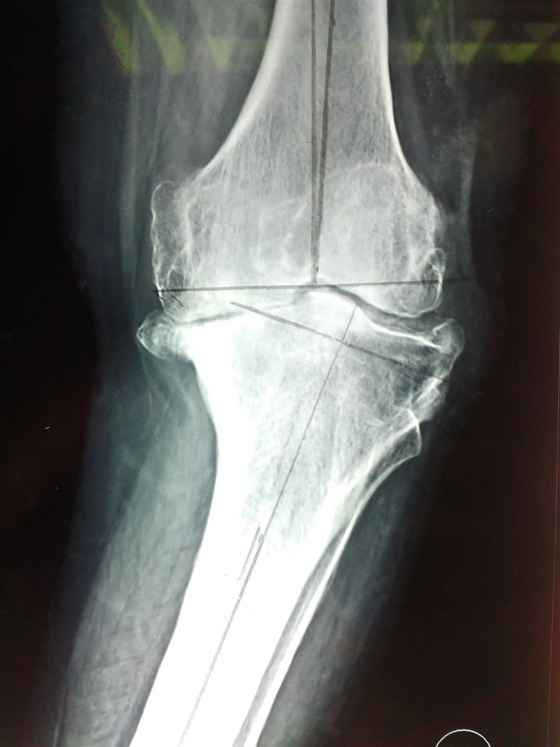 TKA Sagittal Plane Balancing Recon Orthobullets
