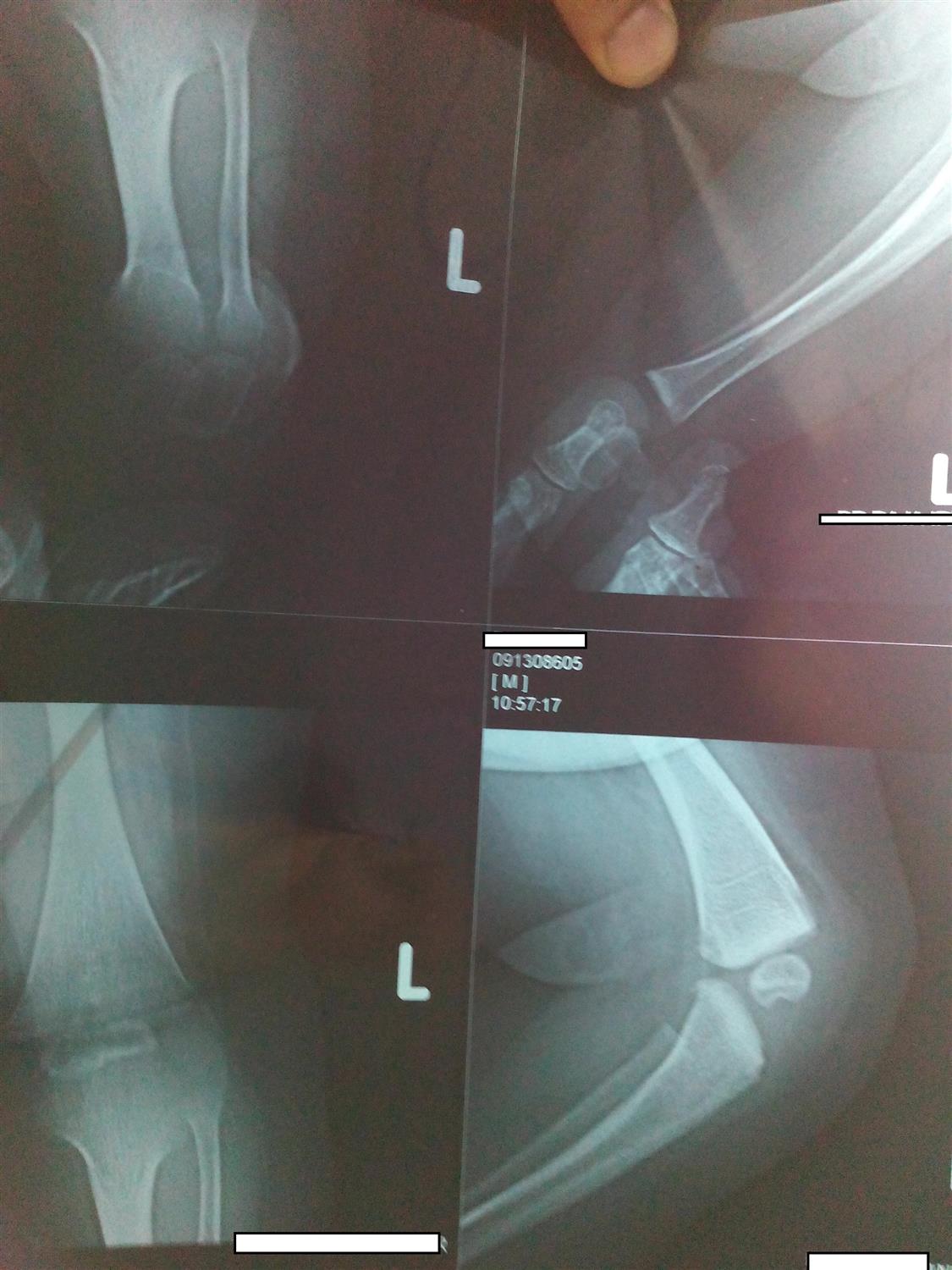 Forearm Compartment Syndrome Neonate Trauma Orthobullets