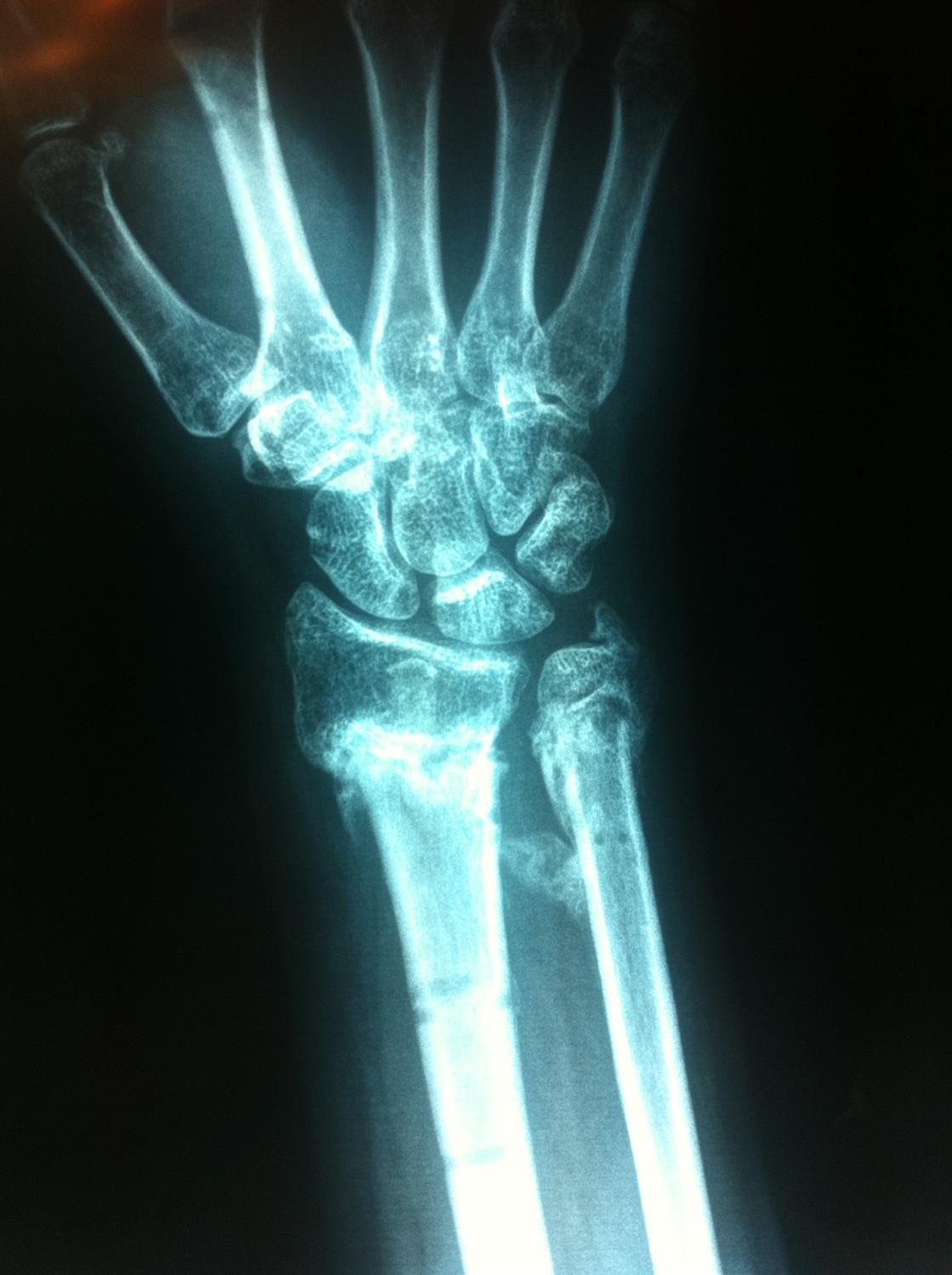 Distal Radius Fractures Trauma Orthobullets