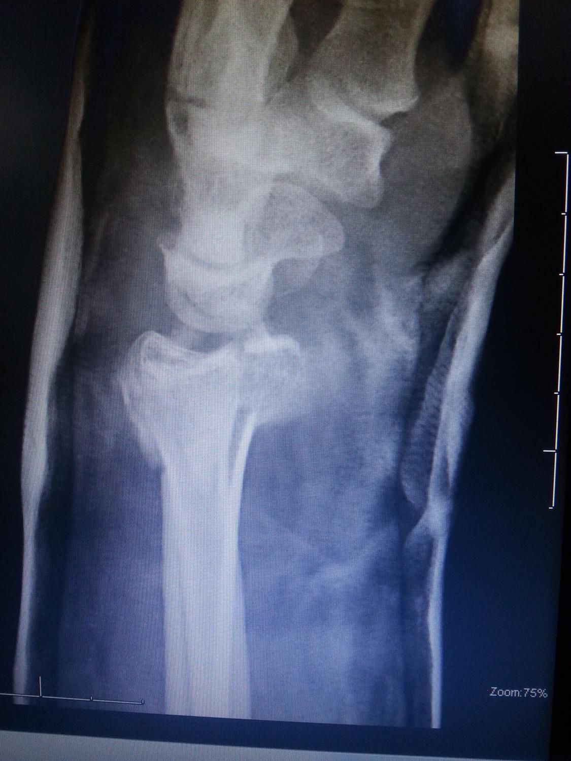 Distal Radius Fractures Trauma Orthobullets