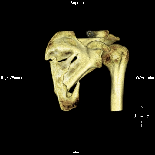 Scapula Fractures Trauma Orthobullets