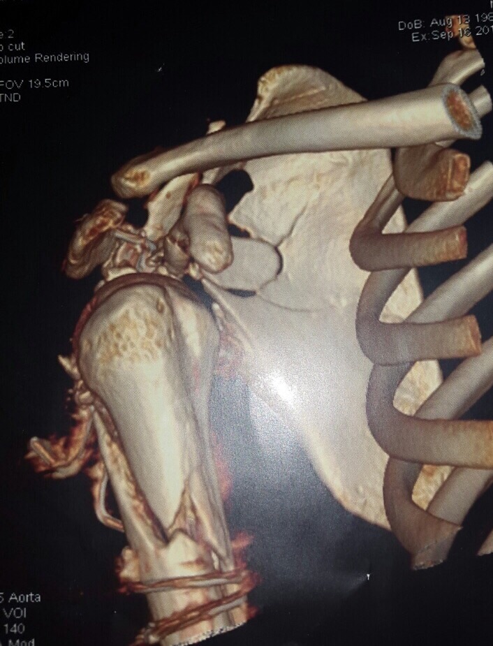 Scapula Fractures Trauma Orthobullets