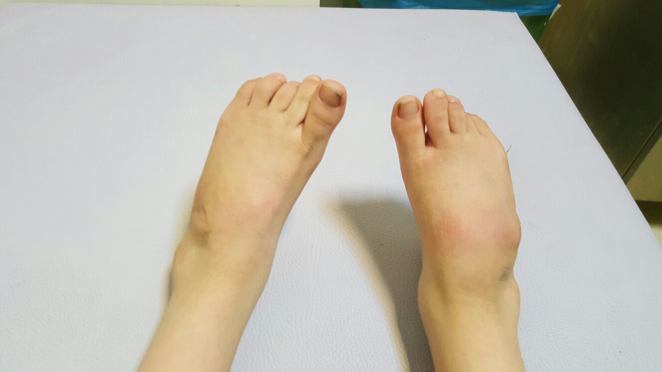 Acquired Spastic Equinovarus Deformity Foot & Ankle Orthobullets
