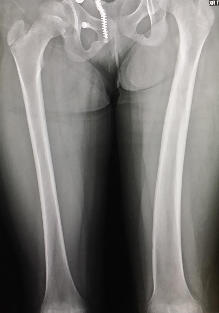 Hemihypertrophy - Pediatrics - Orthobullets