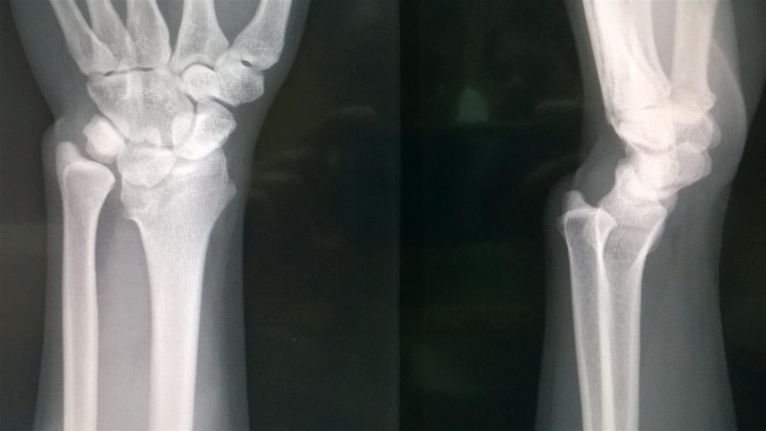 Madelung's Deformity Hand Orthobullets