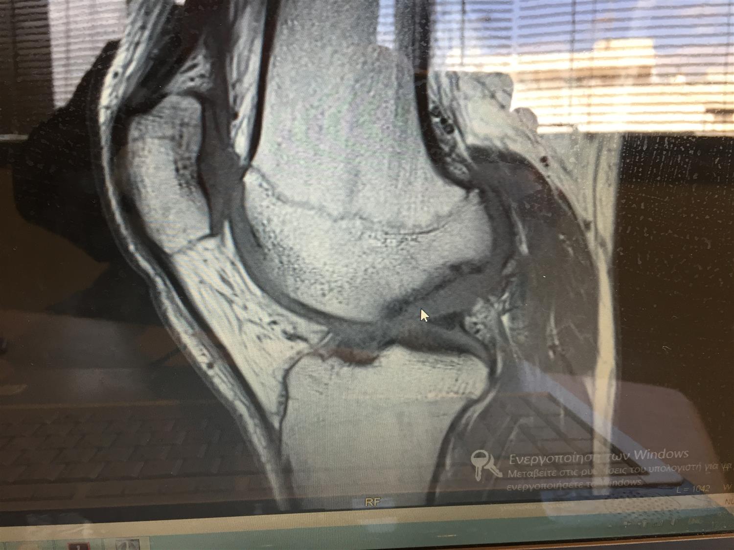 Osteochondritis Dissecans Knee & Sports Orthobullets