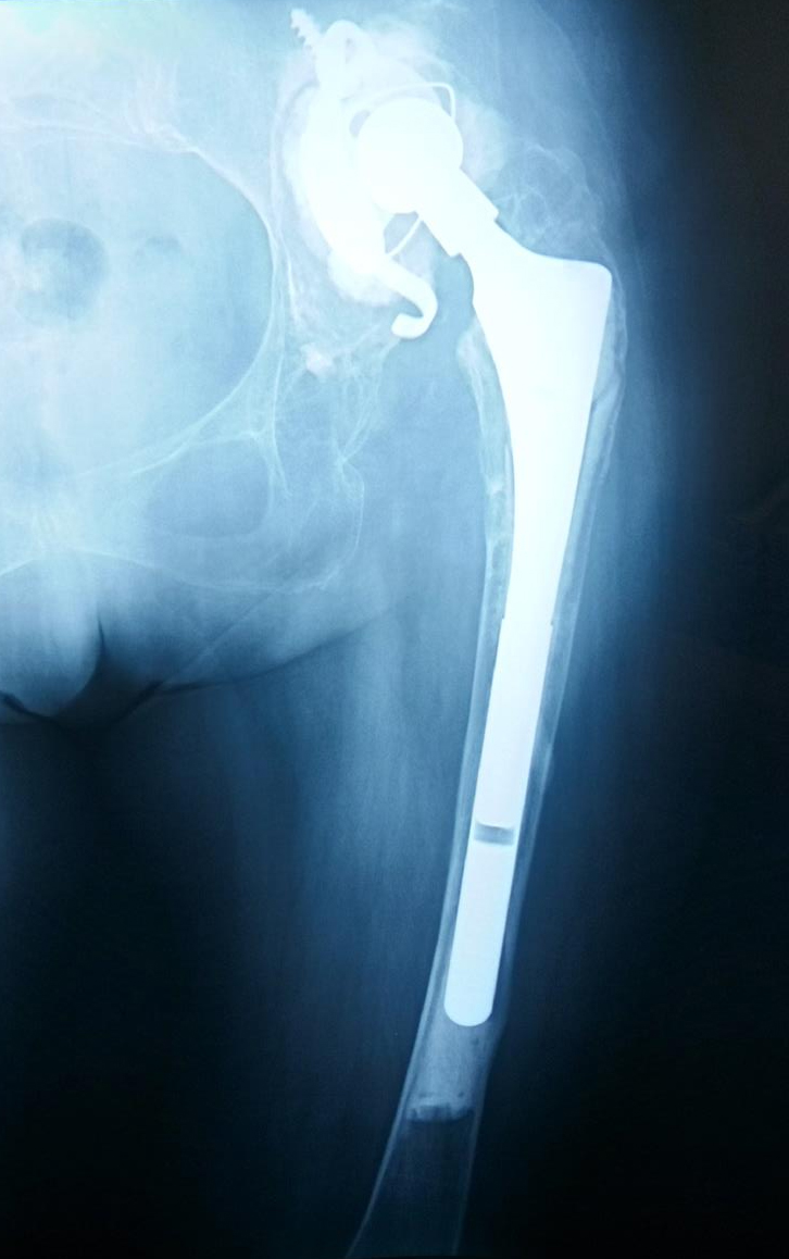 Adult Dysplasia of the Hip Recon Orthobullets