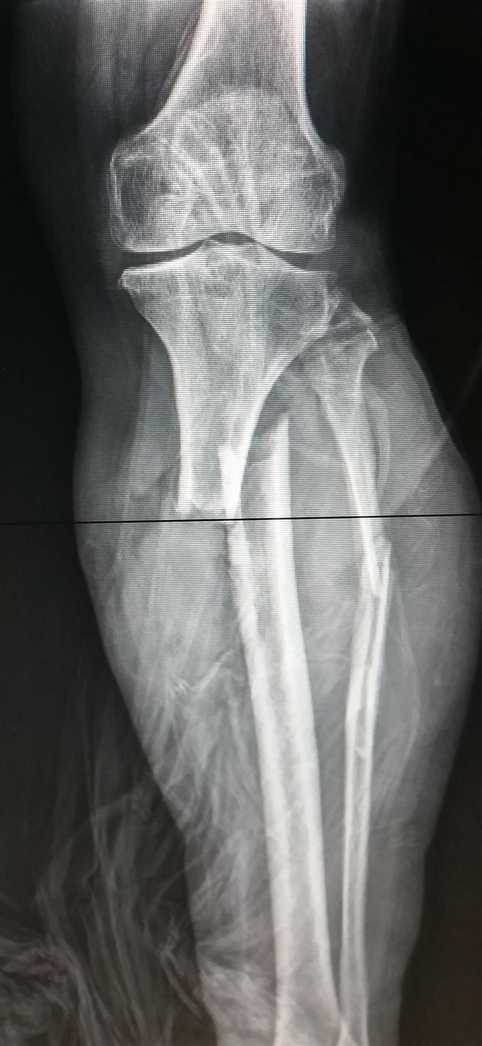 Open Fractures Management Trauma Orthobullets