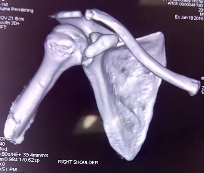Scapula Fractures Trauma Orthobullets