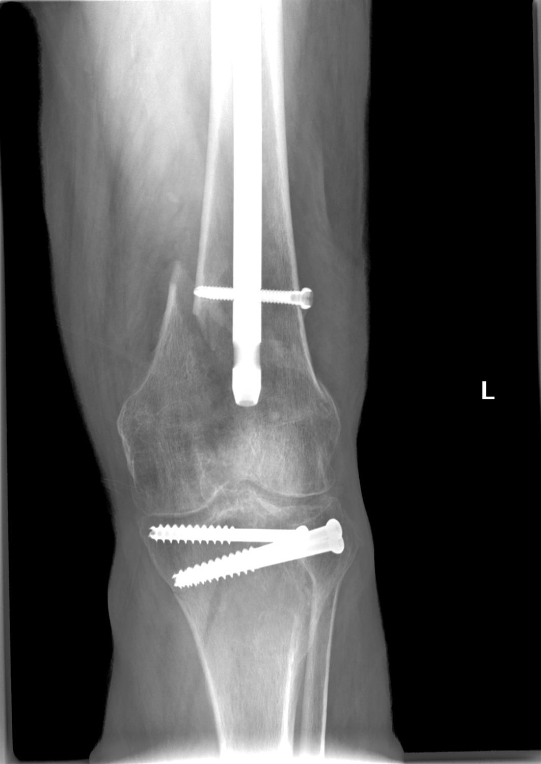 closed fracture of right femur icd 10