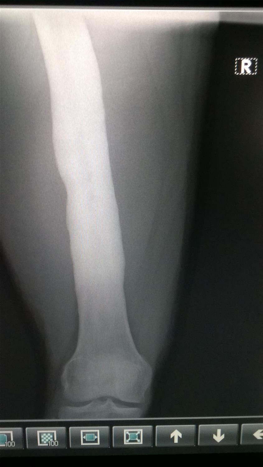 Osteomyelitis Adult Trauma Orthobullets