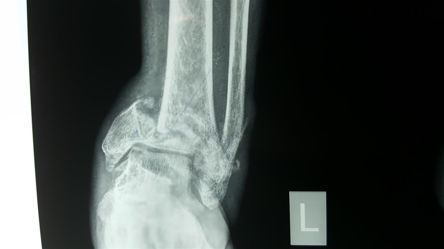 Ankle Fractures Trauma