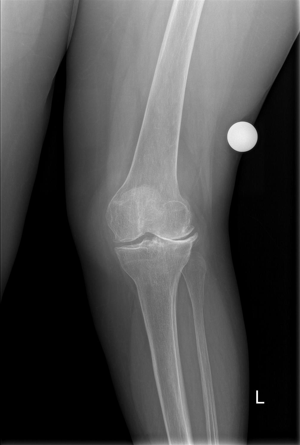 Adult Dysplasia of the Hip Recon Orthobullets