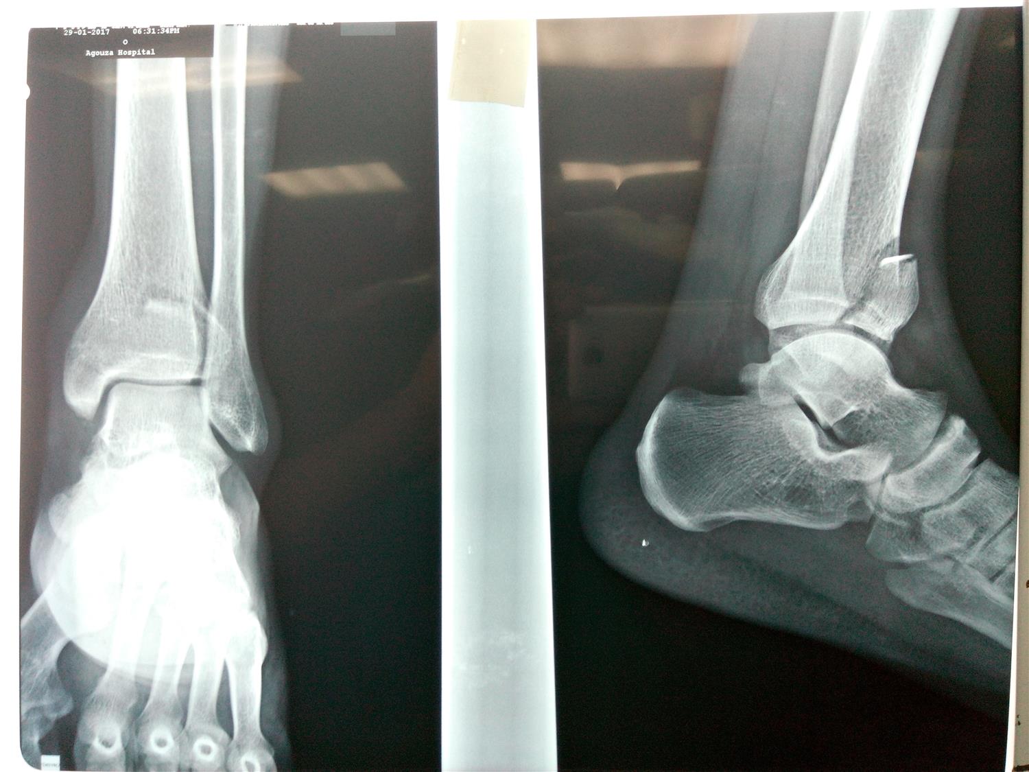 Ankle Fractures Trauma