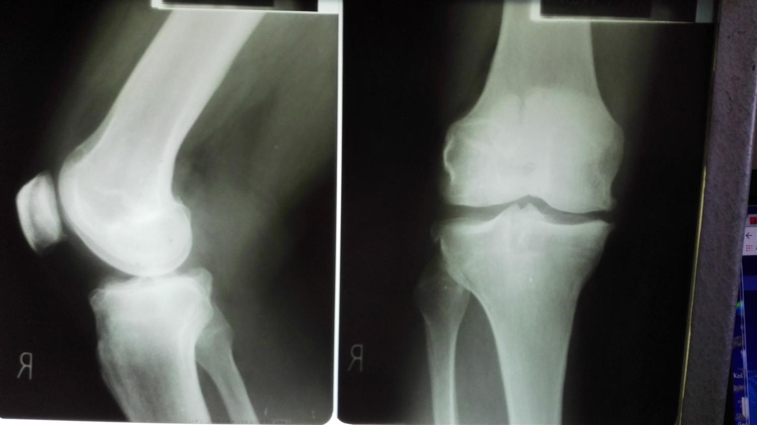 Meniscal Cysts Knee & Sports Orthobullets