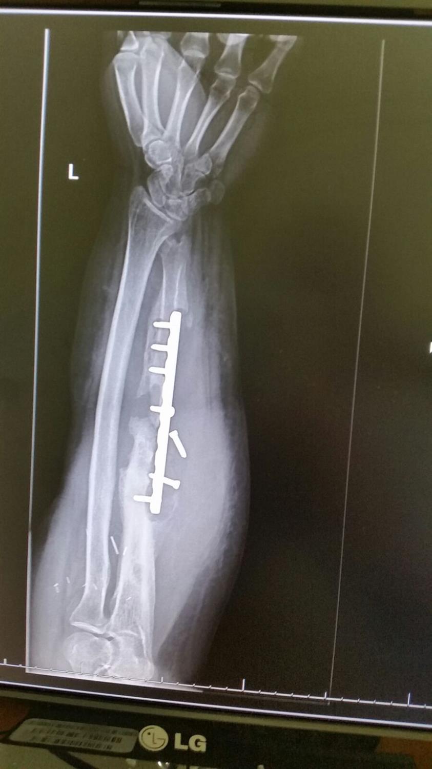 Radius and Ulnar Shaft Fractures Trauma Orthobullets