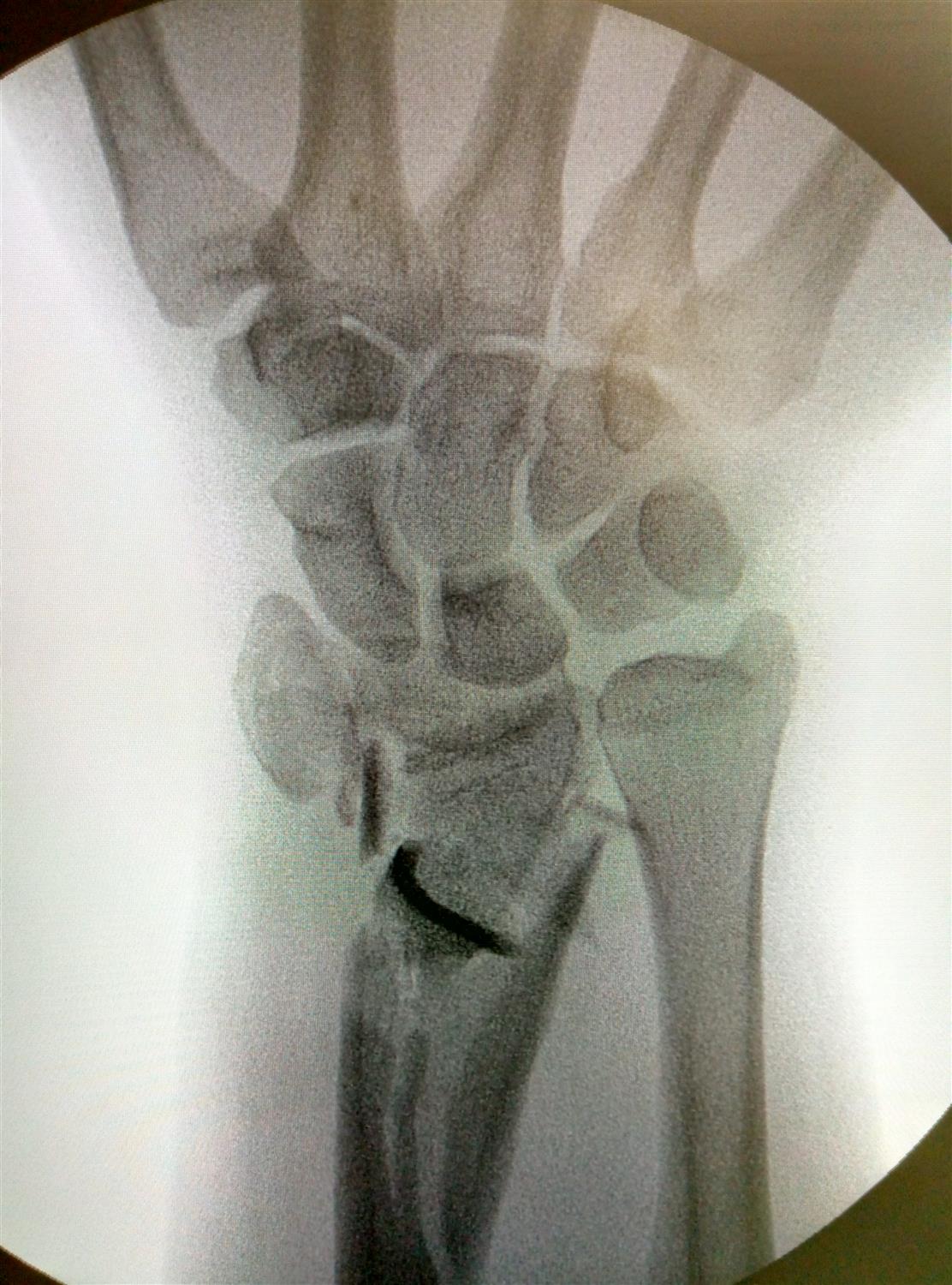 Distal Radius Fractures Trauma Orthobullets