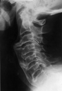 diptic diffuse idiopathic