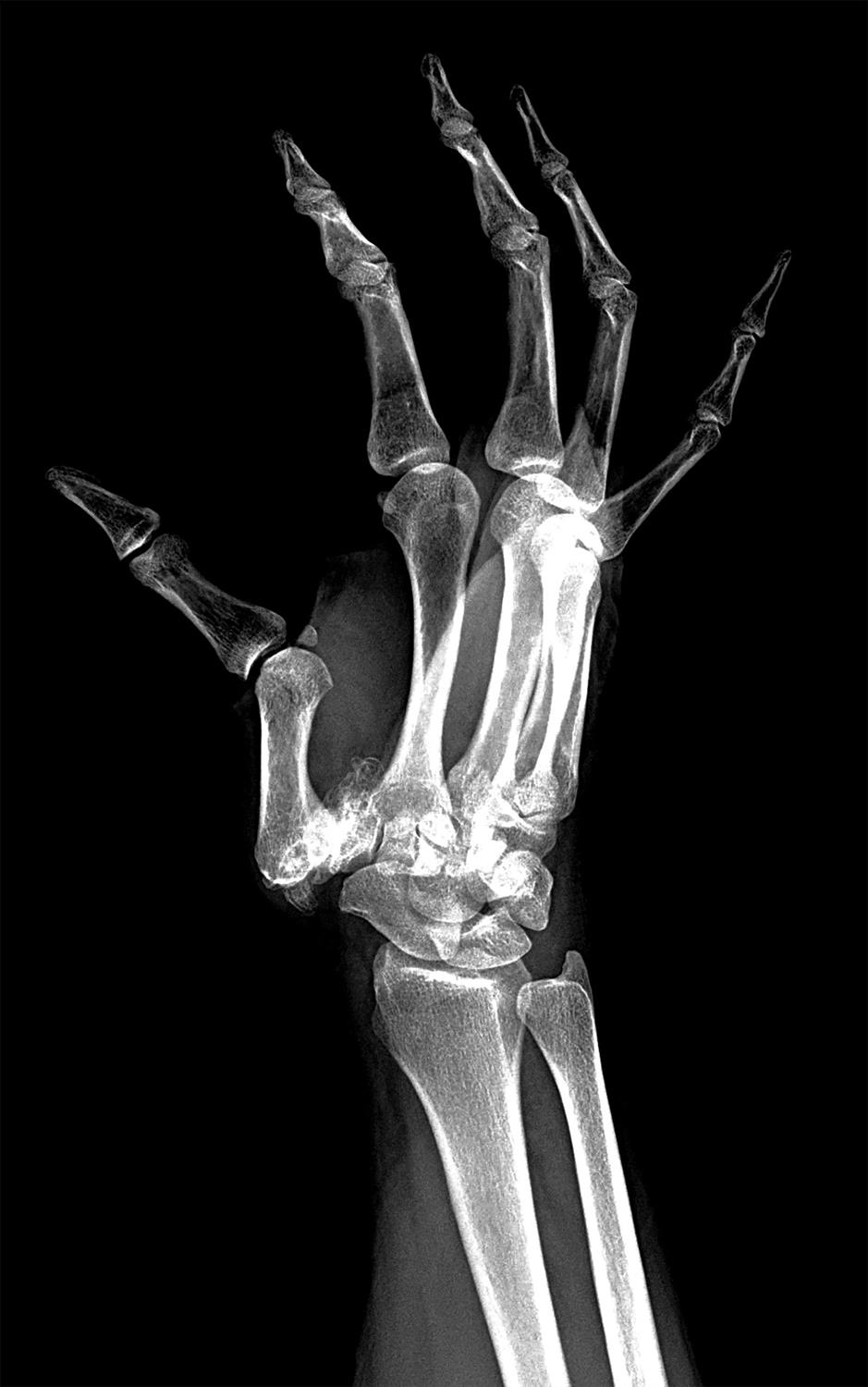 Basilar Thumb Arthritis Hand Orthobullets