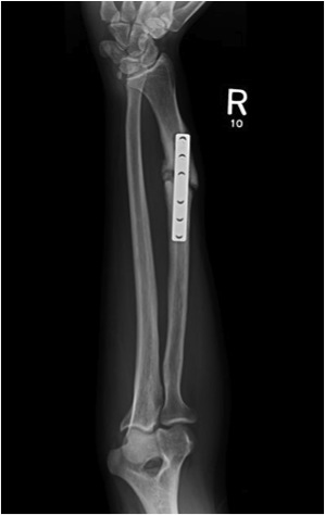 Nonunion And Bone Defects Basic Science Orthobullets Nonunion And Bone Defects Basic Science Orthobullets