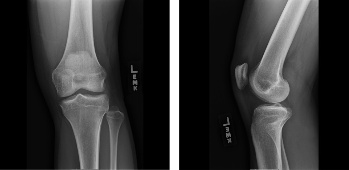 Question 219100 - Qbank - Orthobullets