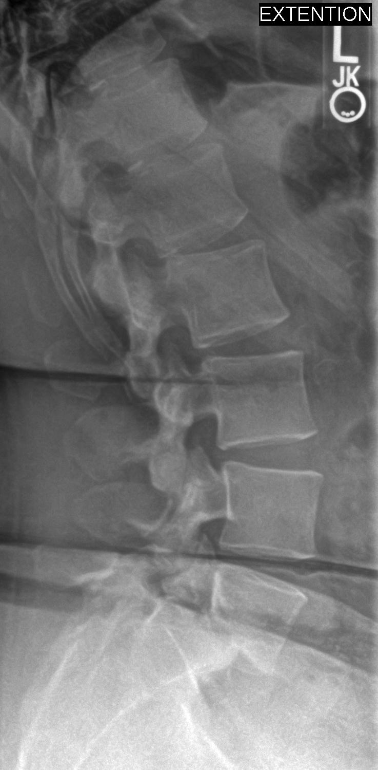 Adult Isthmic Spondylolisthesis Spine Orthobullets