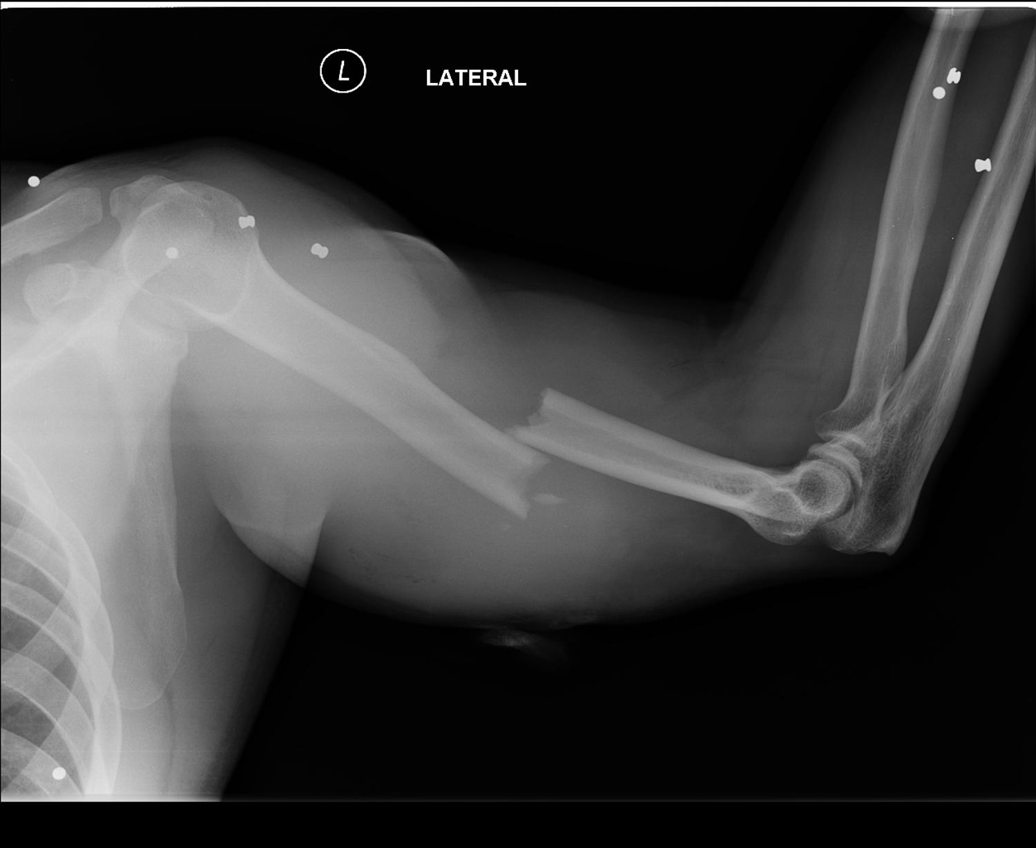 Spiral Humerus Fracture Orthobullets At Sherry Ramos Blog Spiral Humerus Fracture Orthobullets At Sherry Ramos Blog