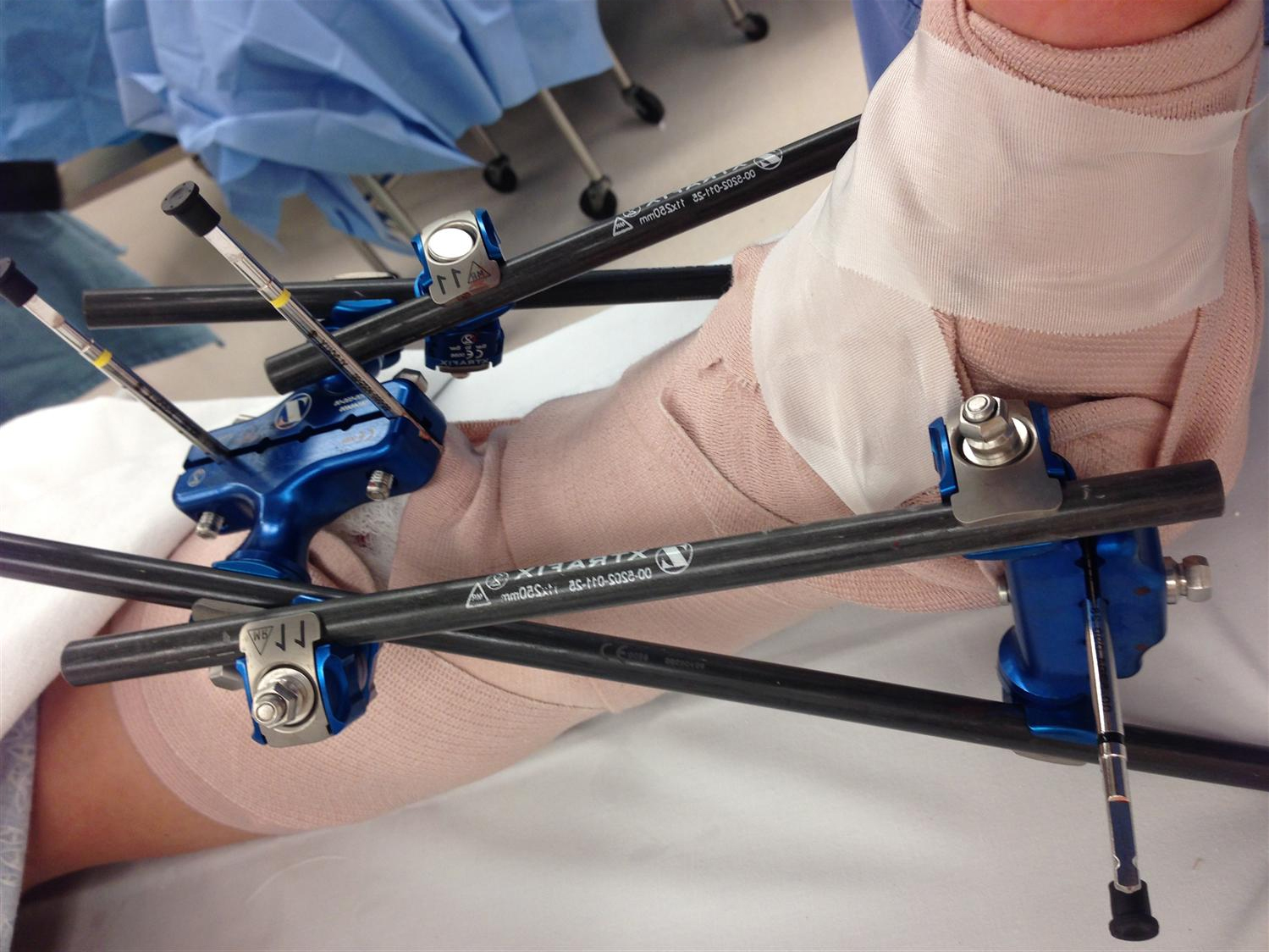 Tibial Plafond Fractures - Trauma - Orthobullets