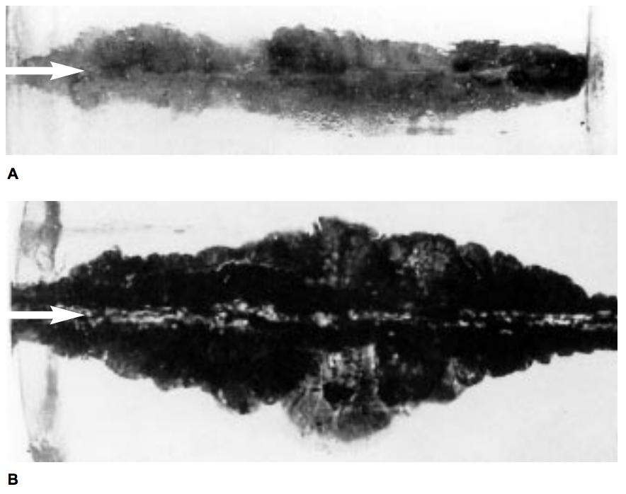 Gun Shot Wounds Trauma Orthobullets