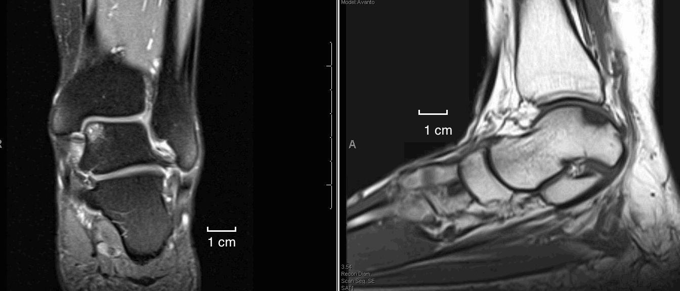 Talus Bone Mri At Cristina Lee Blog Talus Bone Mri At Cristina Lee Blog