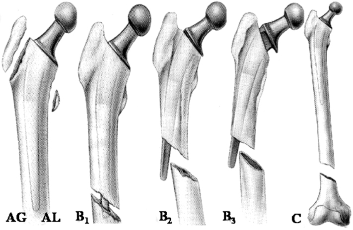 THA Periprosthetic Fracture Recon Orthobullets